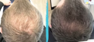 Best PRP Leeds Hair Loss and Facial