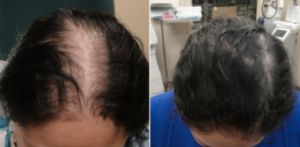 PRP Treatment Cardiff
