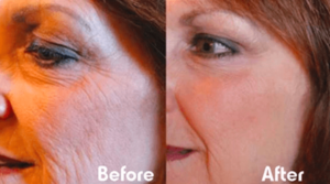 Best PRP Vampire Facial Carlisle