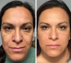 Best PRP Vampire Facial Sheffield City Centre