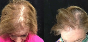PRP Hair Loss Treatment Barnsley