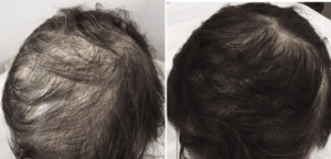 PRP Hair Treatment London