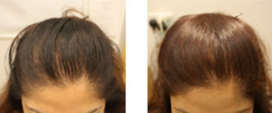 PRP Treatment Glasgow