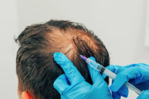 Best Reading PRP Treatment Hair Loss