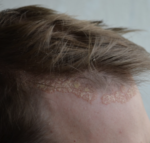 Belgravia Hair Loss Clinic London
