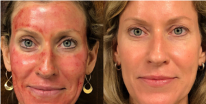 prp facial treatment cheshire, Prp facial treatment cheshire price, Prp facial treatment cheshire near me, Prp facial treatment cheshire cost, Best prp facial treatment.