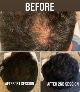 prp for hair loss before and after