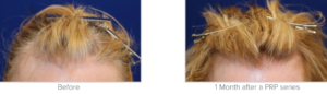 Complete Guide to PRP Treatment UK