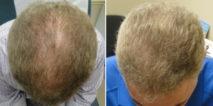 Best PRP Treatment Bristol